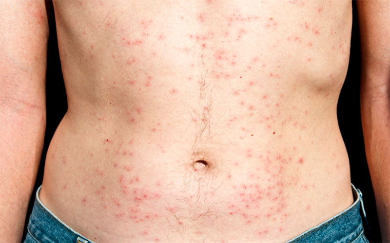 hot tub folliculitis